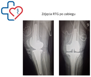 Zdjęcia RTG po zabiegu