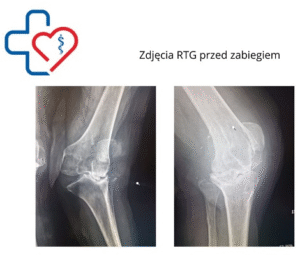 Zdjęcia RTG przed zabiegiem